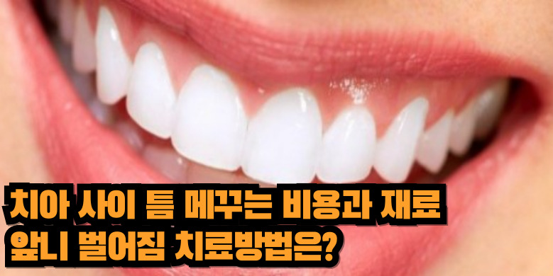 치아 사이틈 치료